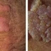 علایم و شیوه انتقال زگیل تناسلی در مردان (HPV)